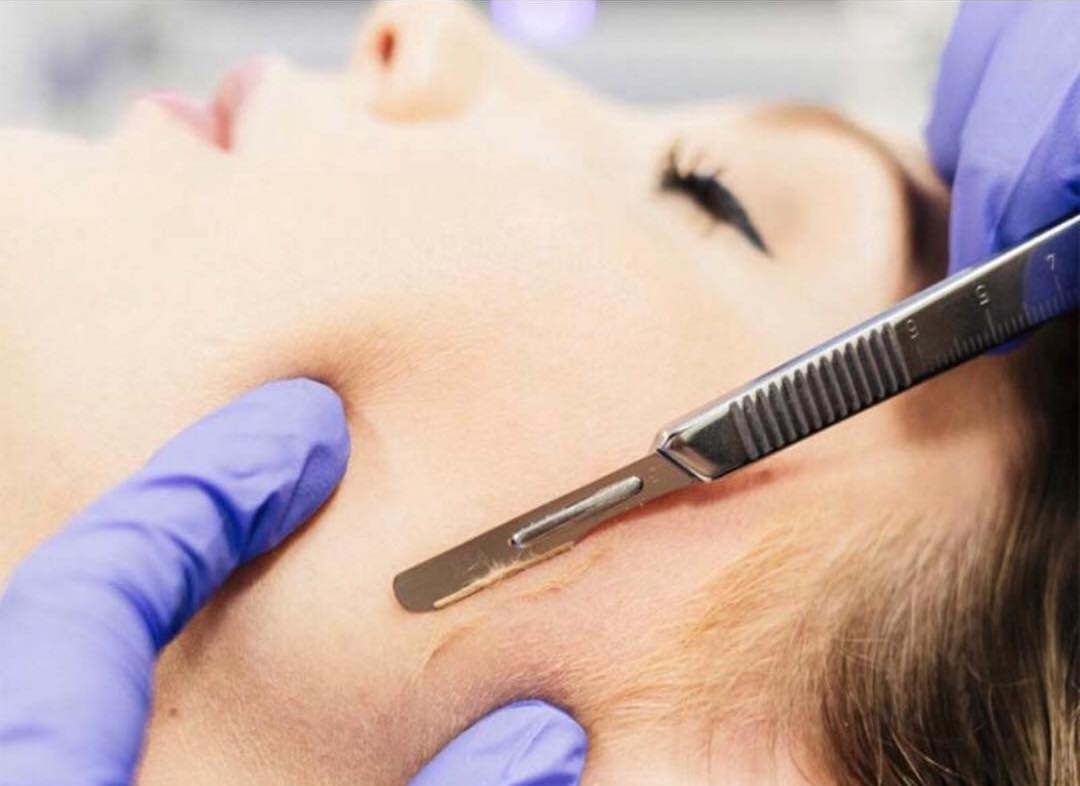 dermaplaning facial