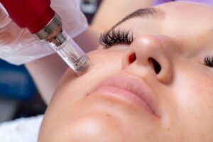 microneedling facial treatment