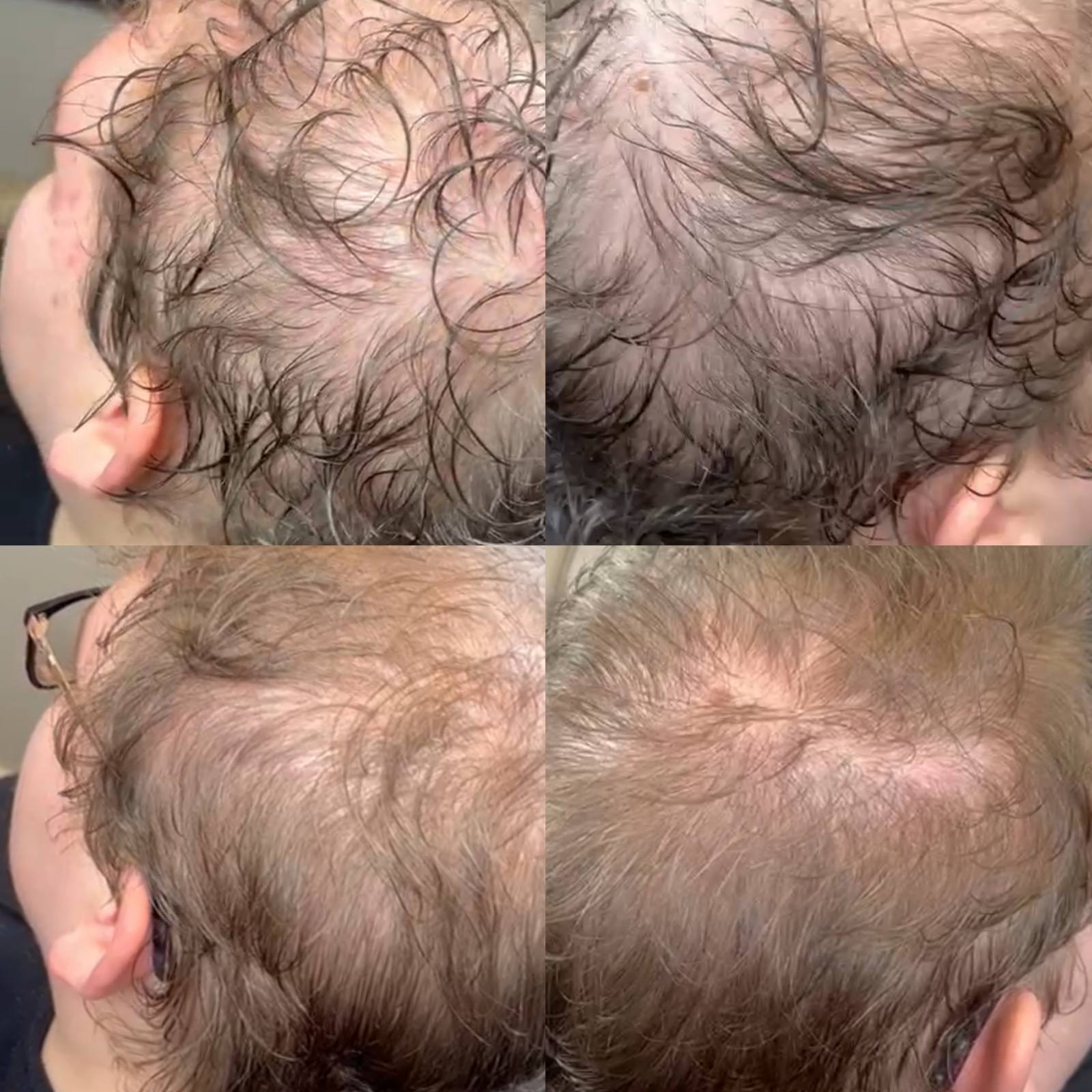 Androgenic Alopecia with SMP