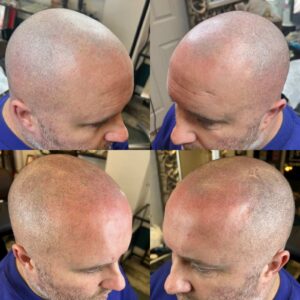 SMP male scalp micropigmentation